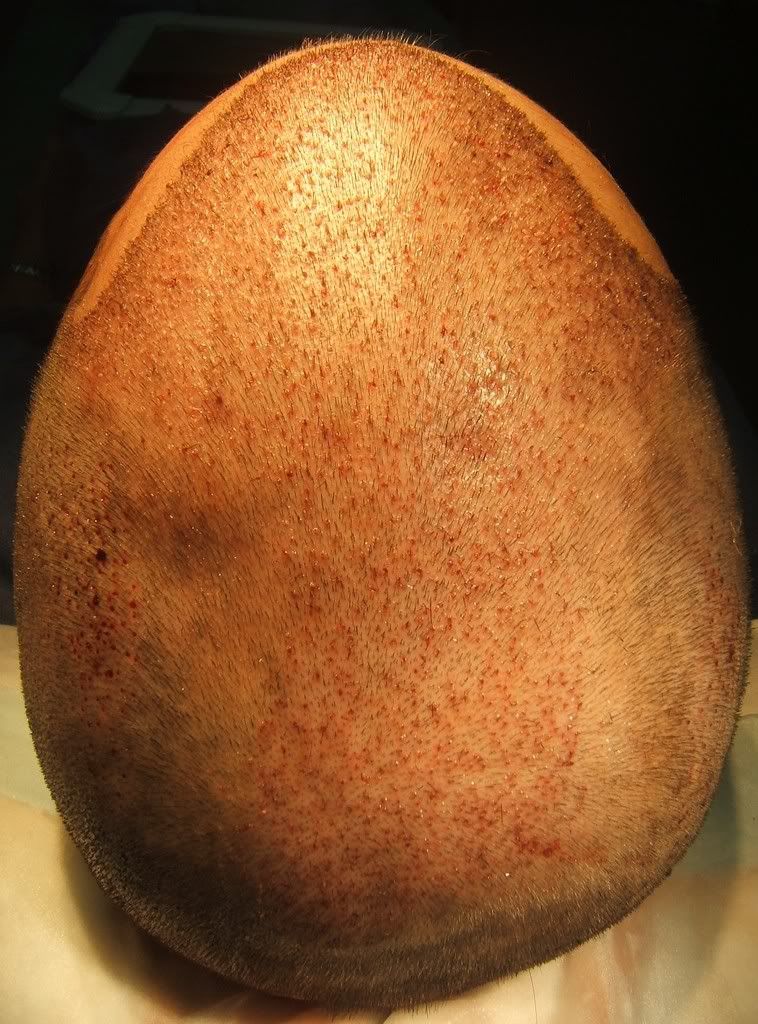 Operacion De Microinjerto De Pelo